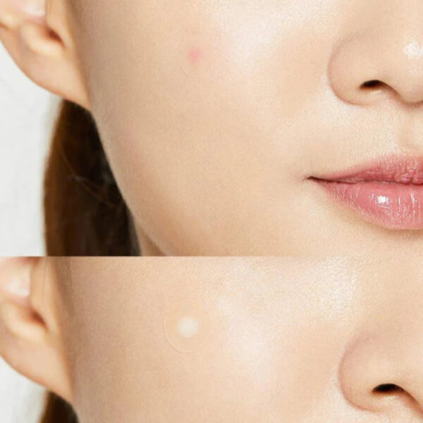 cosrx acne pimple master patch